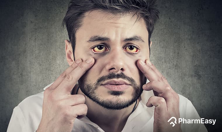 Jaundice Home Remedies: Dr. Siddharth Gupta's Expert Advice