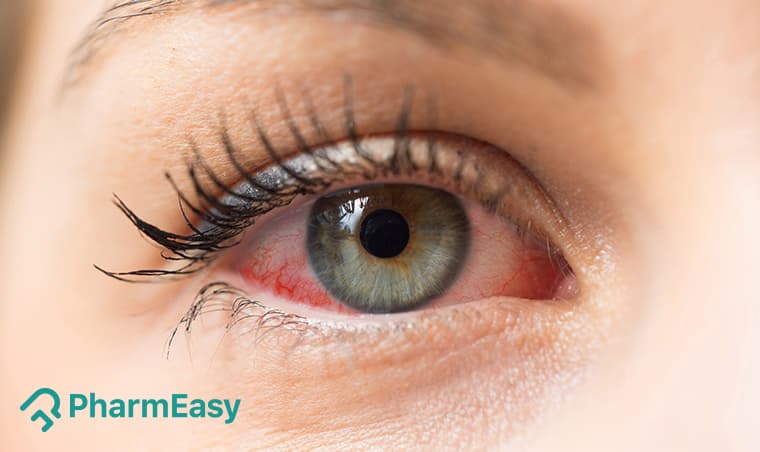 Red Eyes: Effective Home Remedies & When to See a Doctor