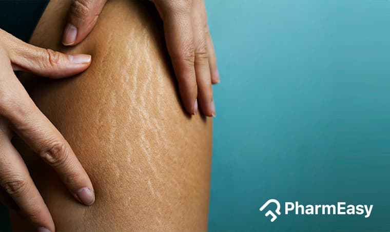 Natural Stretch Mark Remedies: Home Treatments That Work