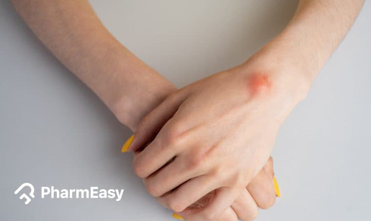 Lipoma Home Remedies: Effective & Natural Treatments