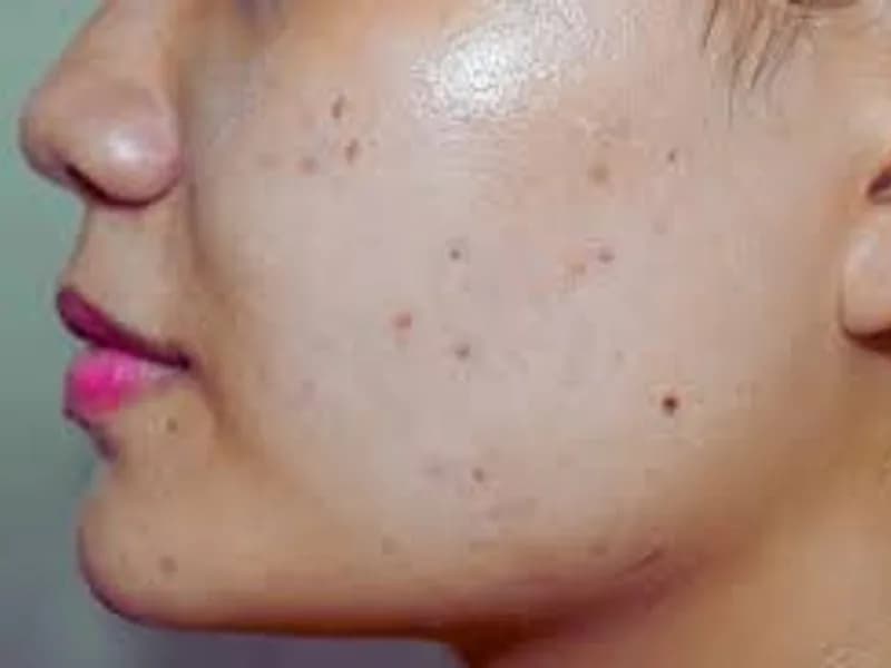 Fade Dark Spots: Expert Guide to Clearer Skin