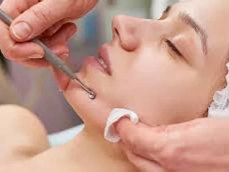 Acne Treatment Options: A Doctor's Guide to Clearer Skin