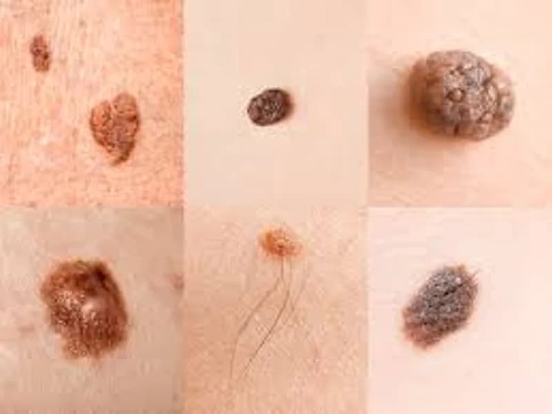 Skin Cancer Signs: What to Look For & When to See a Doctor