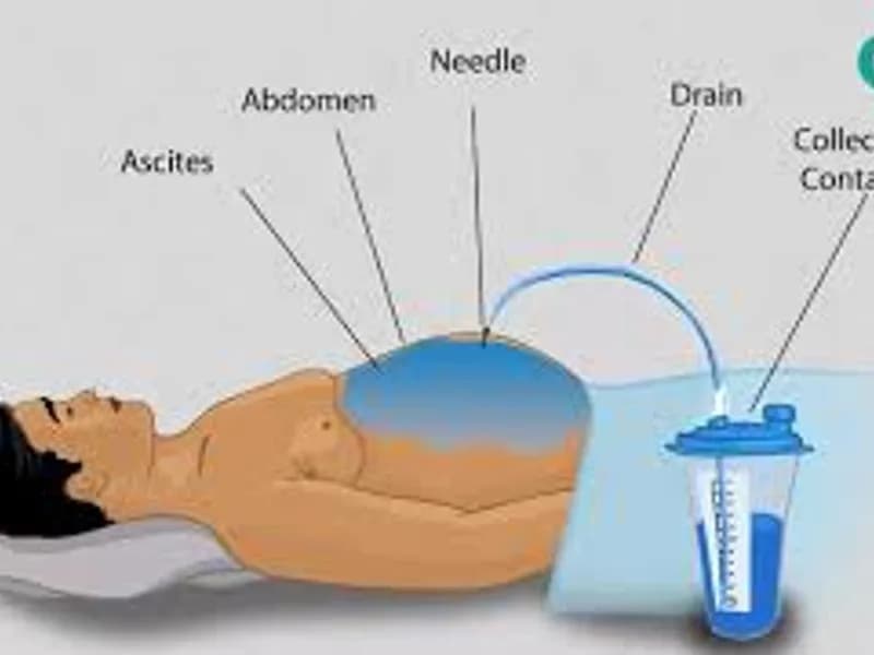 Amylase Drain Fluid Test: What It Is & Why It's Done