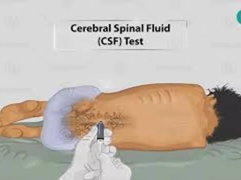 Protein CSF Test: What It Is, Why It's Done