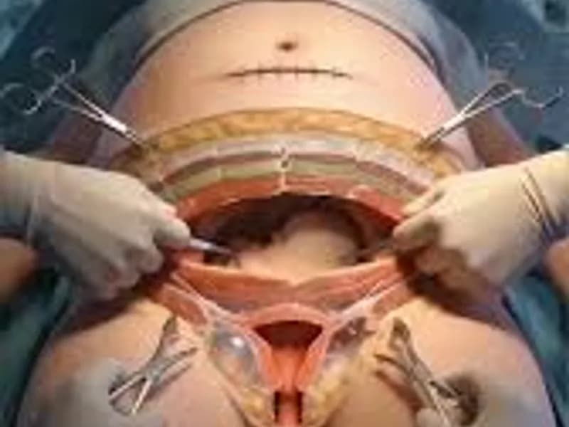 C-Section Surgeon Kolkata: Finding the Best Care for You