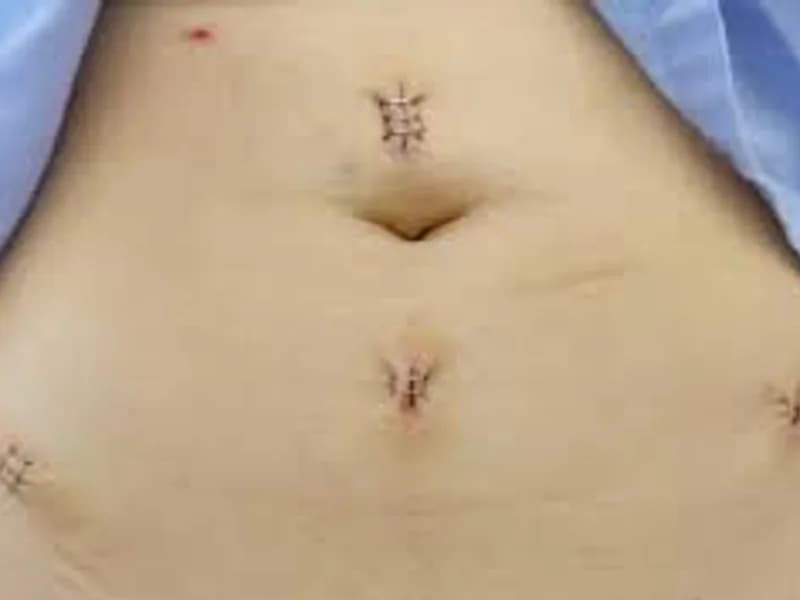 Ovarian Cyst Removal Surgery in Kolkata: Expert Care