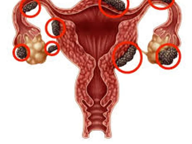 Endometriosis Surgery in Kolkata: Expert Care & Options