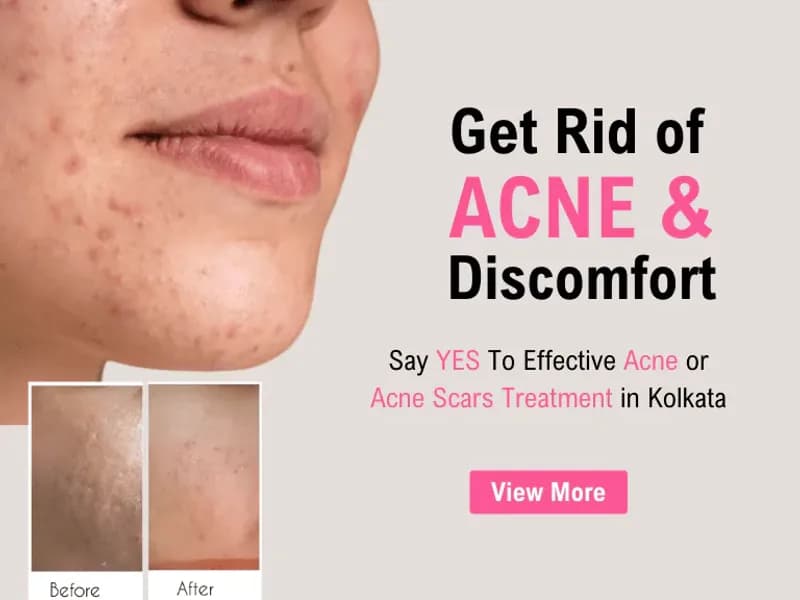 Tattoo Removal in Kolkata