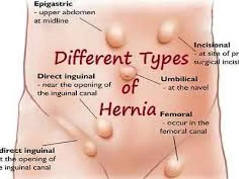 Best Hernia Doctor Near Me in Kolkata: Advanced Hernia Care