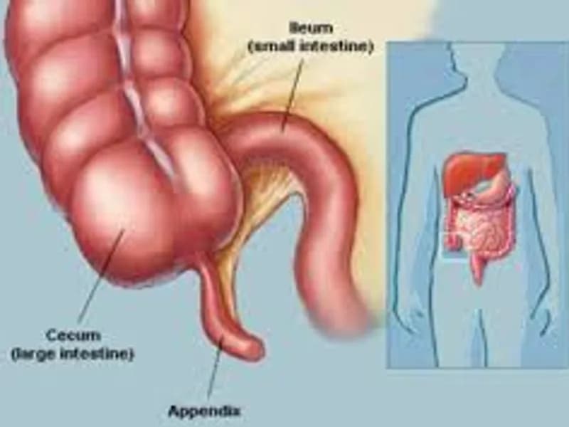 Best Appendicitis Specialist in Kolkata: Advanced Appendix Care