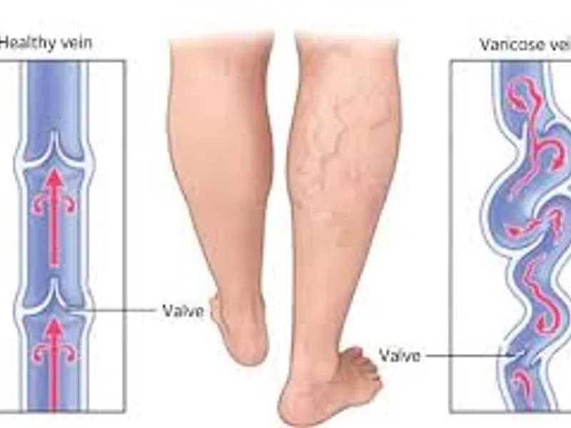 Best Varicose Veins Doctor in Kolkata: Top Vein Care