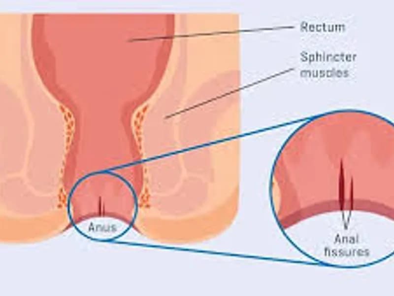 Best Fissure Specialist India in Kolkata: Top CareBest Fissure Specialist India in Kolkata: Top Care