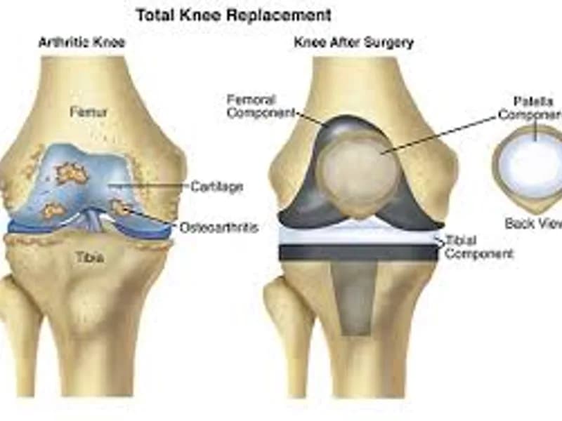 Knee Replacement Surgery in India: Cost, Benefits & Recovery