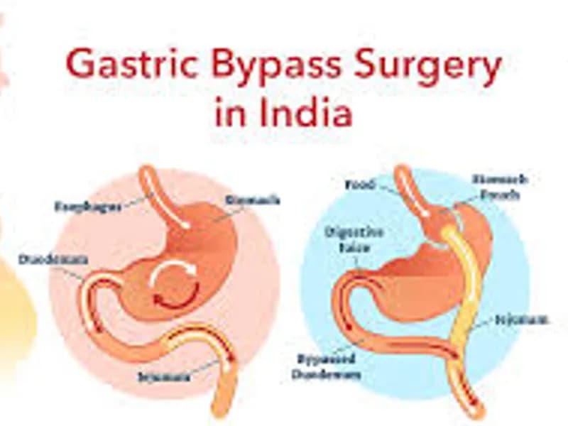 Title: Best Gastric Bypass Surgeon India: Expert Metabolic Care