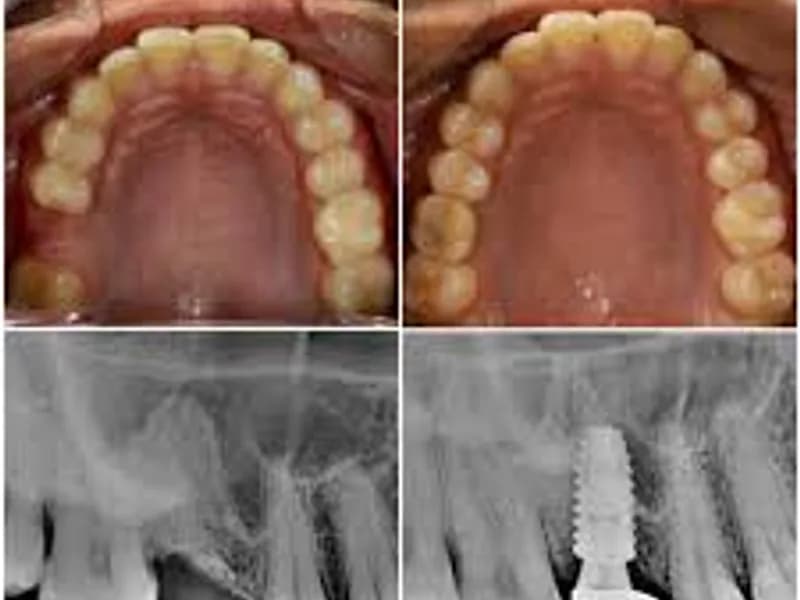 Best Tooth Implant Specialist India: Top Dental Care