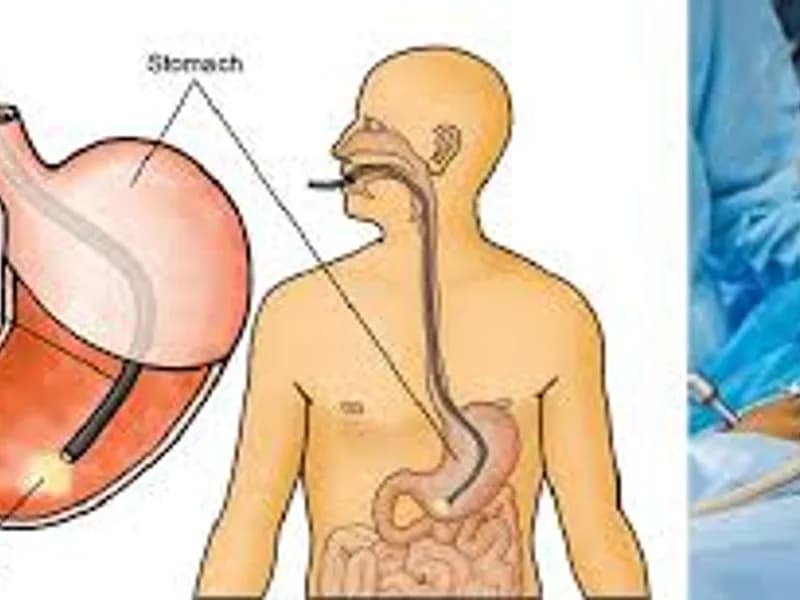 Best Gastroscopy Doctor: Expert Upper GI Care Guide