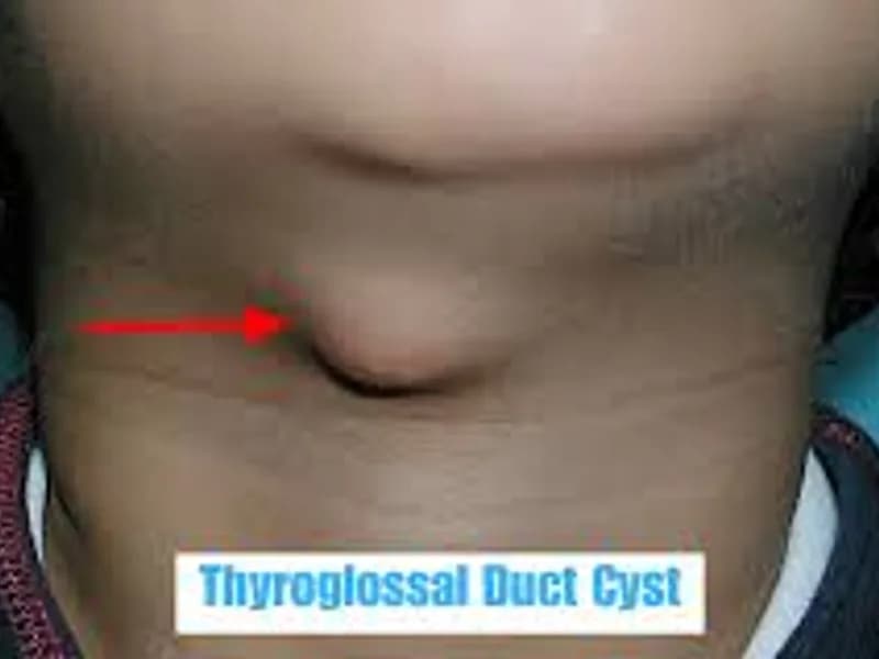 Thyroglossal Duct Cyst Excision Surgery in Deoghar