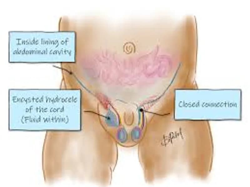 child Hydrocele of Cord treatment in Deoghar