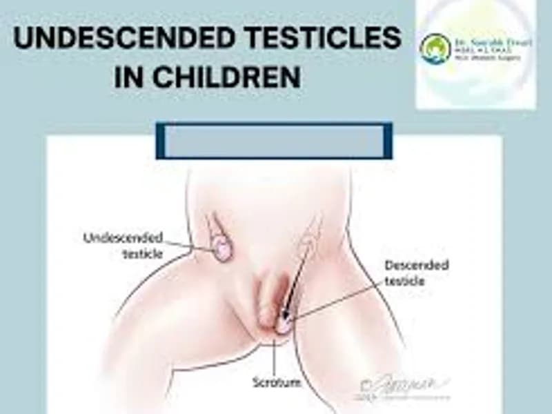 Child Undescended Testis Unilateral Surgery in Deoghar