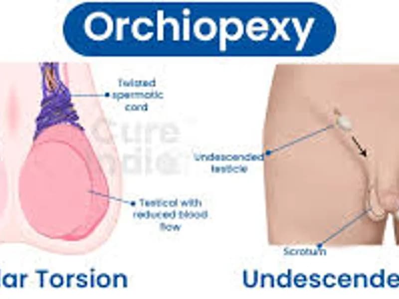 Laparoscopic Orchidopexy Surgery in Deoghar | Best Pediatric Surgeons & Cost 2025