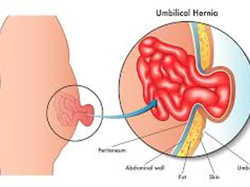 Umbilical Hernia Repair Surgery in Deoghar | Best Hernia Surgeons & Cost 2025