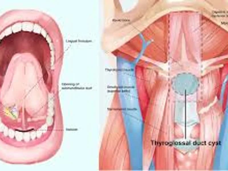 Female excision of thyroglossal duct cyst surgery in Deoghar
