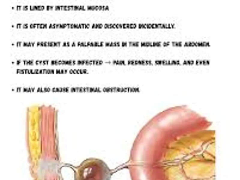 Child omphalo mesenteric cyst excision surgery in Deoghar