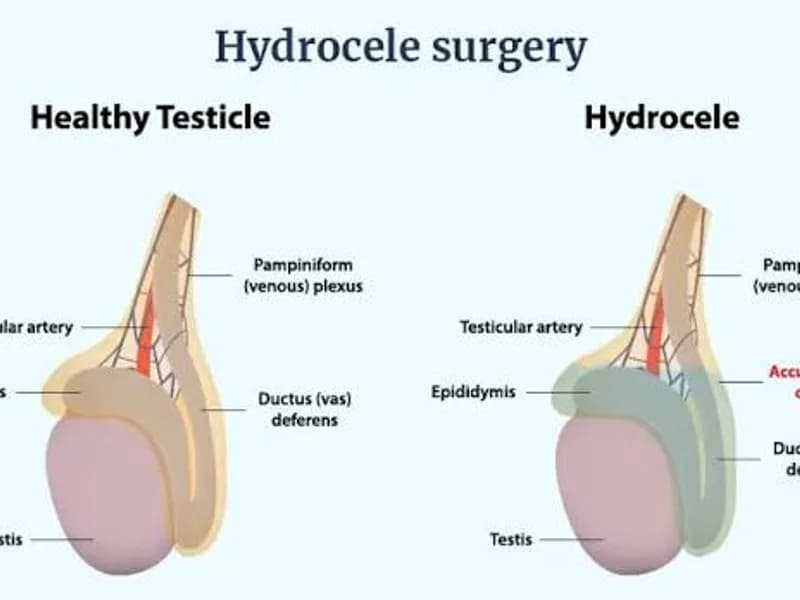Female hydrocele of cord surgery in Deoghar