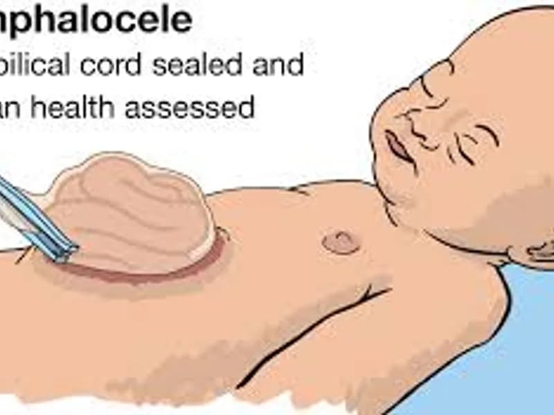 Child omphalocele second stage hernia repair surgery in Deoghar
