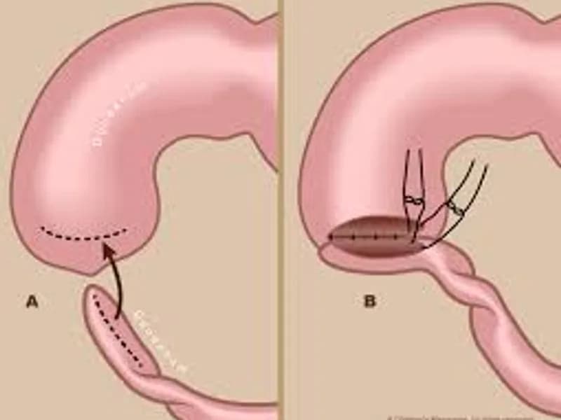 Duodenal Atresia Operation Surgery in Deoghar | Cost, Best Surgeons & Neonatal Intestinal Surgery Guide