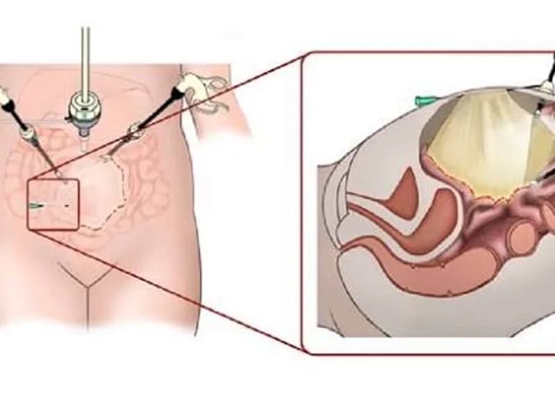 Female Excision of Omental Cyst Surgery in Deoghar