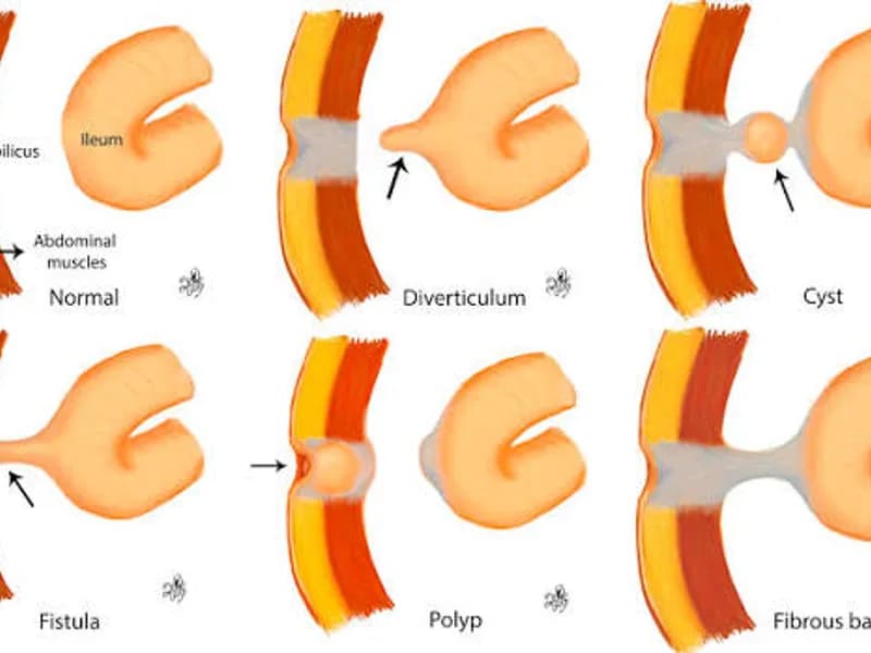 Female Omphalo Mesenteric Duct Excision Surgery in Deoghar