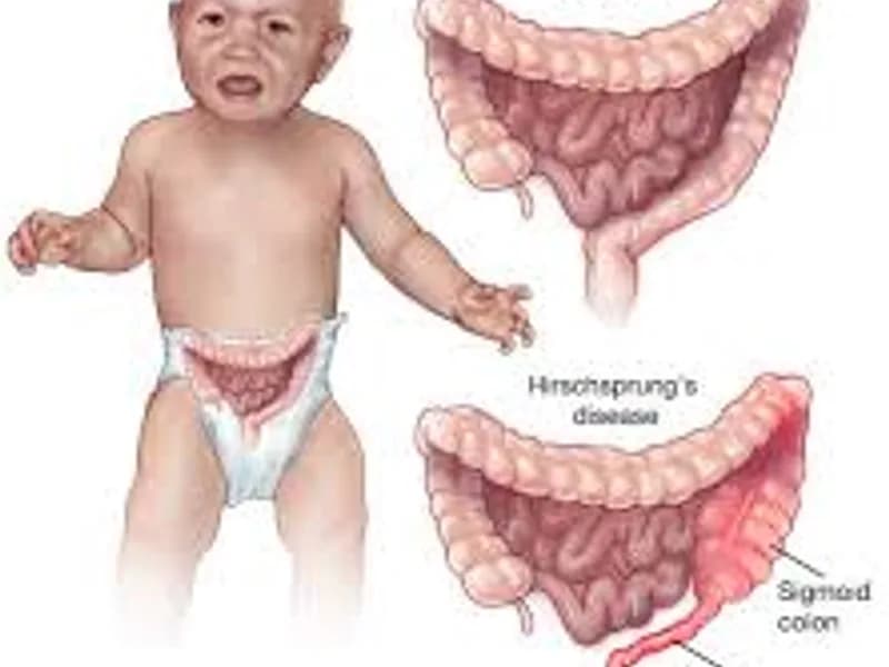 Child abdominal perineal pull through Hirschsprung disease surgery in Deoghar