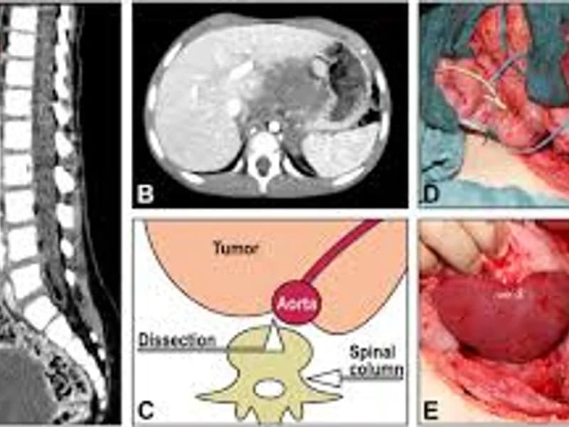 Neuroblastoma Debulking Surgery in Deoghar
