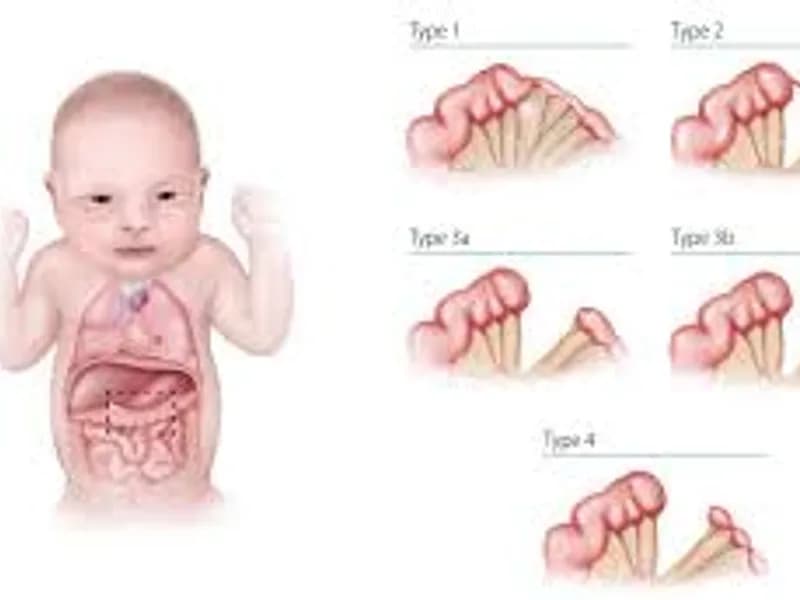 Congenital Atresia Stenosis Small Intestine Surgery in Deoghar