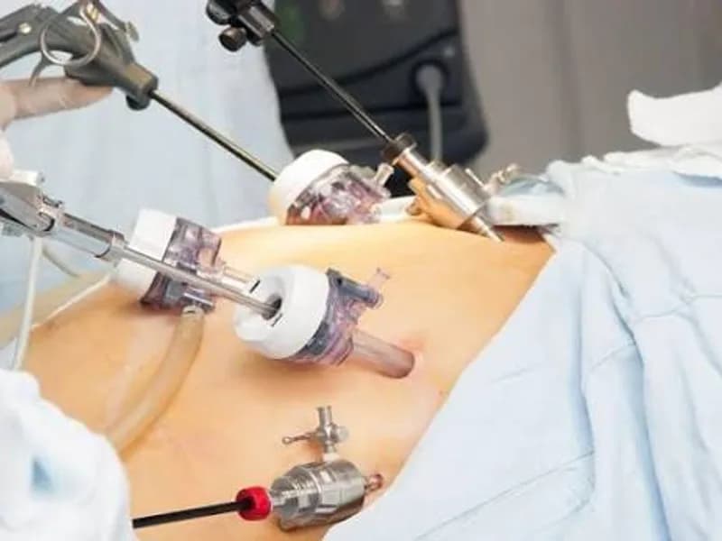 Female Laparoscopic Cholecystectomy Surgery in Deoghar