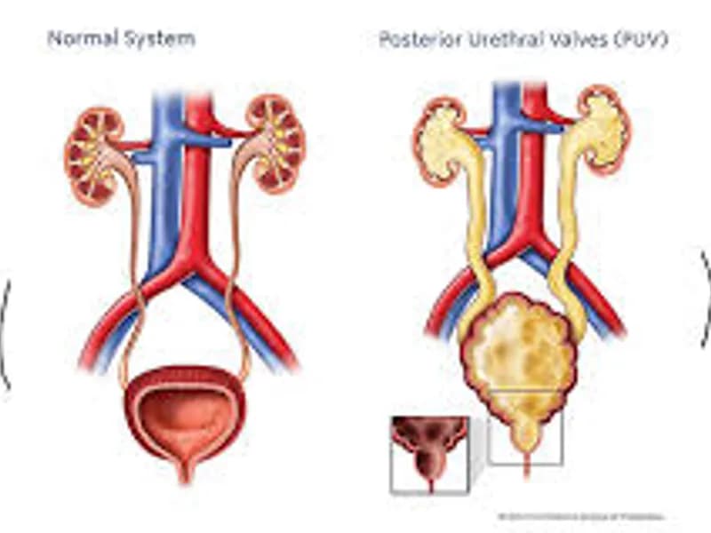 Cystoscopic PU Valve Fulguration Surgery in Deoghar