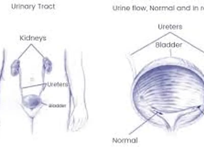 Ureteric Reimplantation Unilateral Surgery in Deoghar
