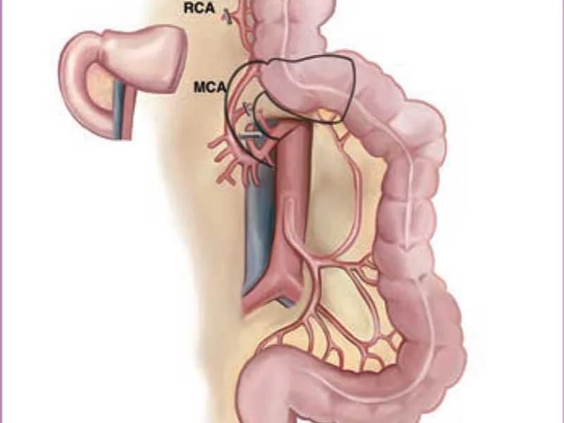Female Colon Replacement of Esophagus Surgery in Deoghar