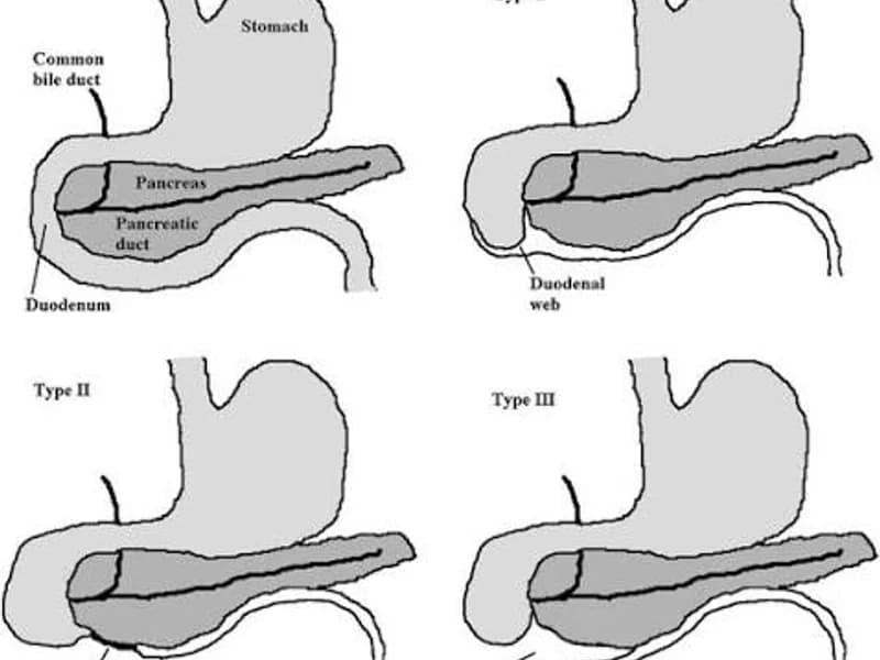 Female Duodenal Atresia Surgery in Deoghar | Top Surgeons