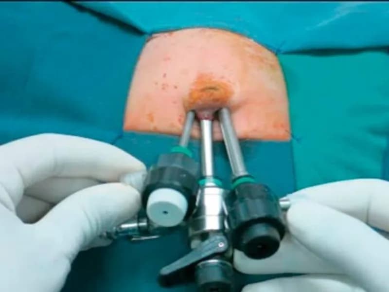 Female Choledochal Cyst Operation Surgery in Deoghar