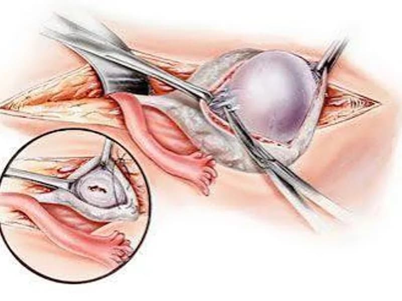 Female Neuroblastoma Debulking Surgery in Deoghar