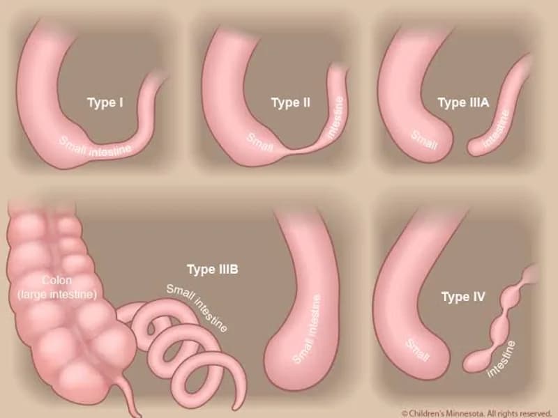 Female Congenital Atresia Stenosis Small Intestine Surgery in Deoghar