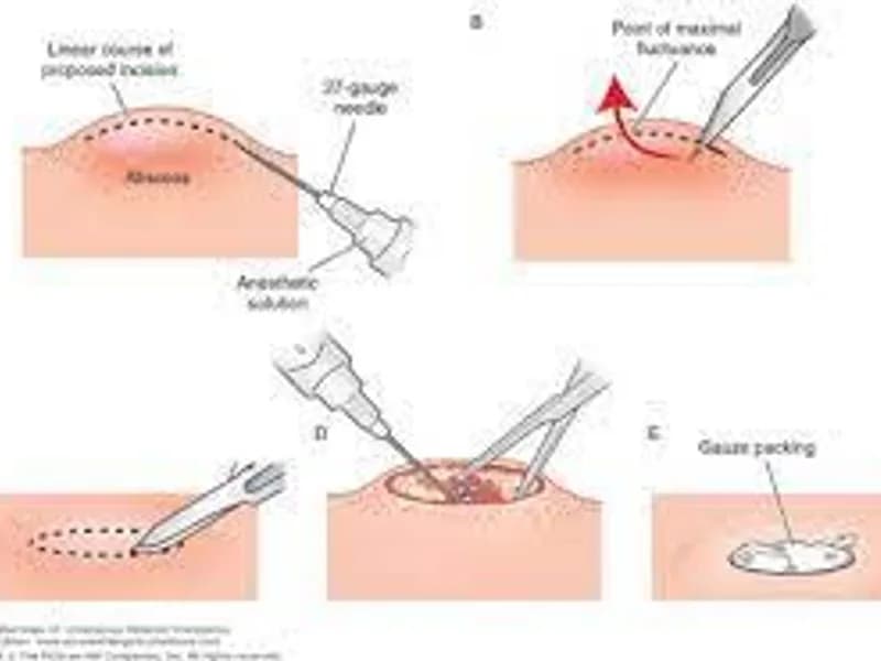 Female Incision and Drainage Surgery in Deoghar