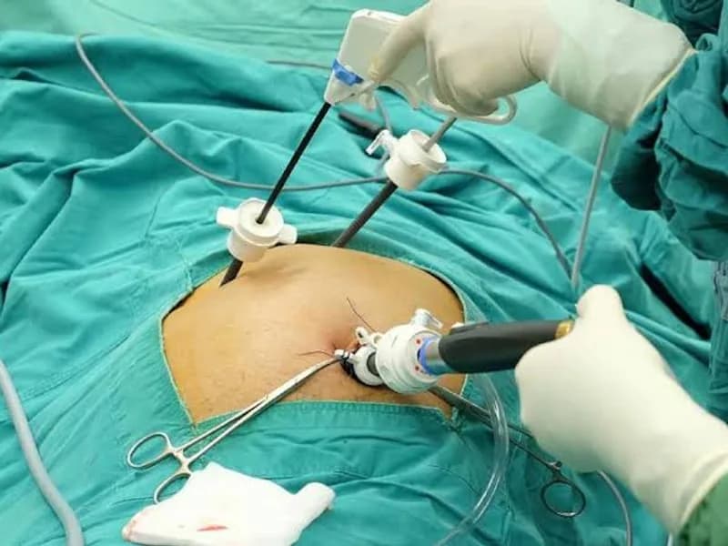 Female Gallstone Surgery in Deoghar