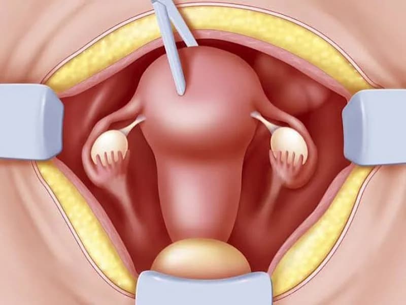 Female Hysterectomy Surgery in Deoghar