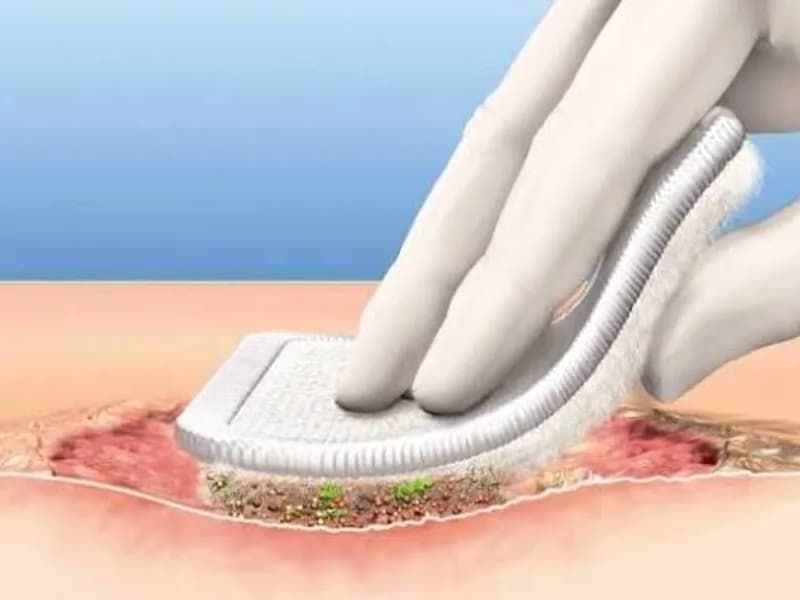 Female Wound Debridement and Dressing Surgery in Deoghar