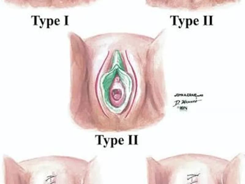 Female Circumcision Surgery in Ranchi