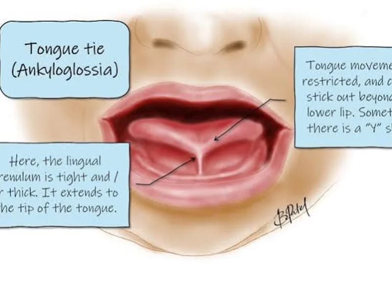 Female Tongue Tie Excision Surgery in Ranchi